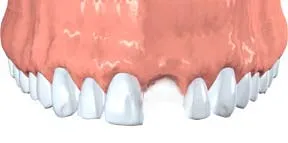 avulsed tooth