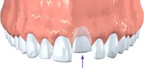 partially pushed back dislodged tooth