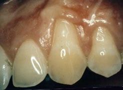 Before Gum Grafting Torrance CA Dentist