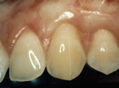 After Gum Graft Torrance CA, MOA Dental Group