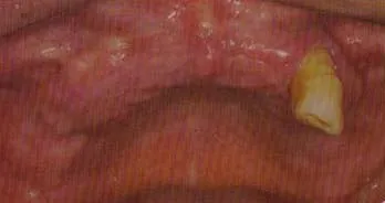 before dental implants
