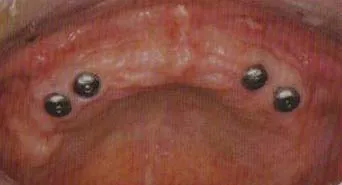 implant posts in gums