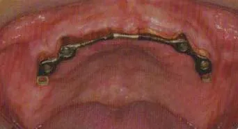 bar attachment for dentures