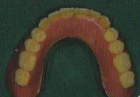 dentures for implant supported overdenture