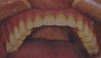 after adding dentures