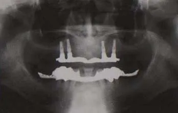 x-ray of implant posts